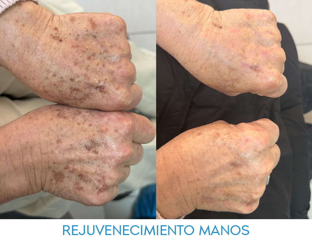 rejuvenecimiento-facial